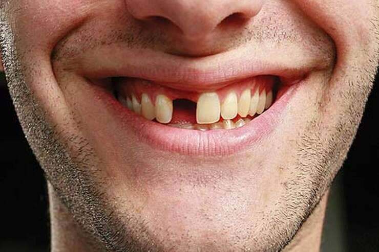 Farmaco fa ricrescere i denti